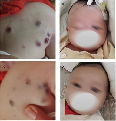 Case report: Blue rubber bleb nevus syndrome with Kasabach-Merritt phenomenon in a neonate